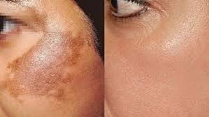 Yellow Peel Face
